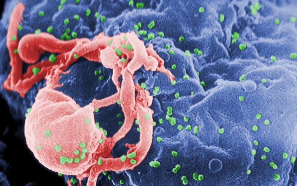 Egy újabb HIV-fertőzött páciens hosszú távú remissziójáról számoltak be kutatók