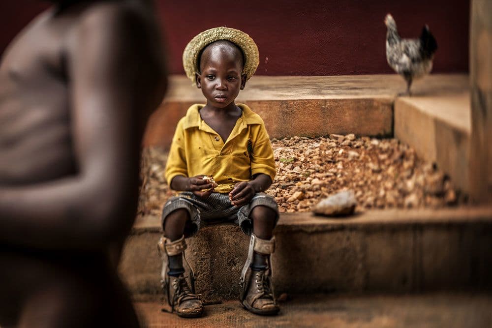 Az év UNICEF-fotója egy művégtagos kisfiú portréja